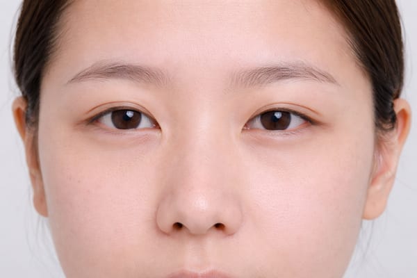 症例6 施術後