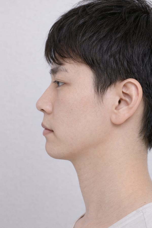 症例14 施術前